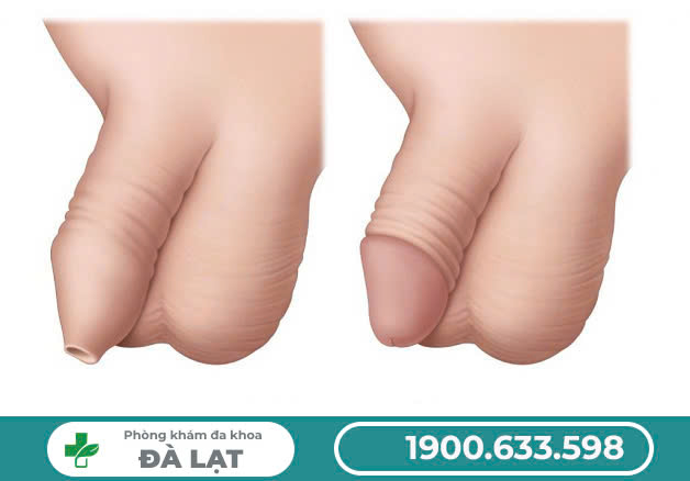 Bao quy đầu không lột được là do đâu?